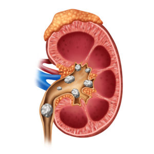 kidney stones