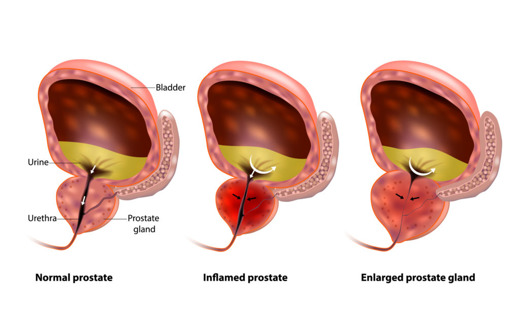 prostatitis